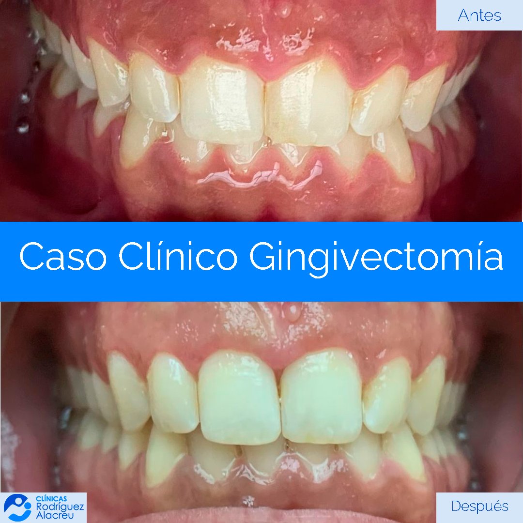 00-plantilla-caso-clinico-gingivectomia-01