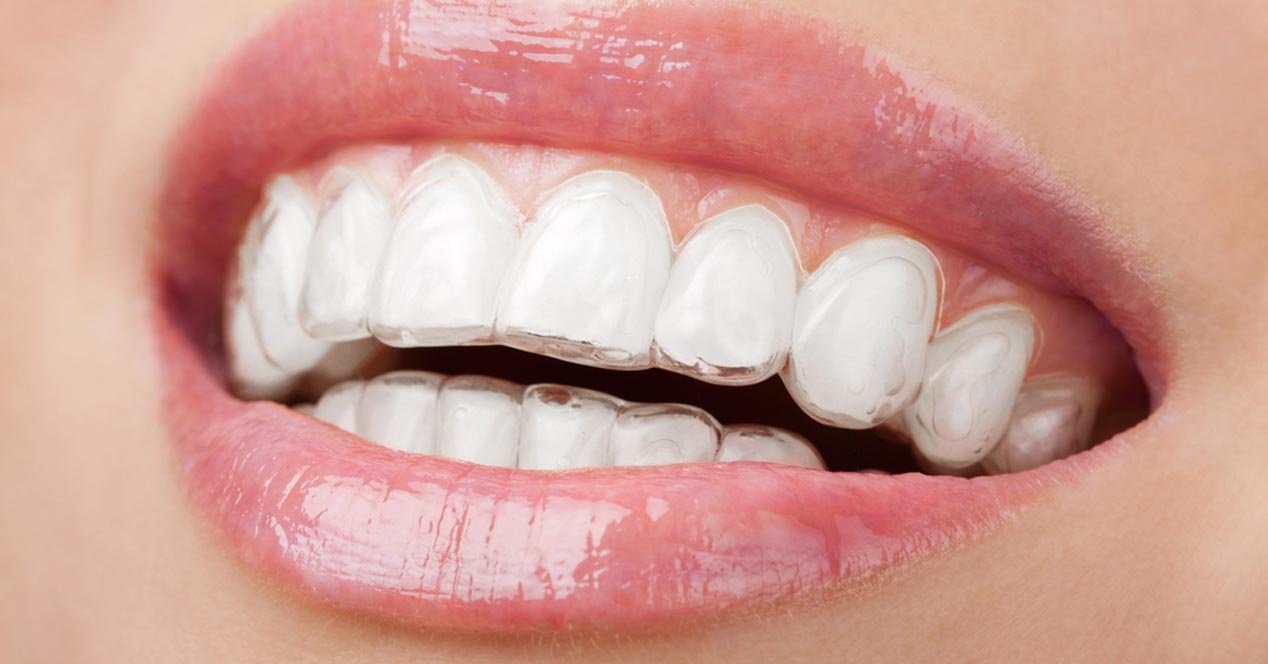 Ortodoncia con Invisalign ventajas
