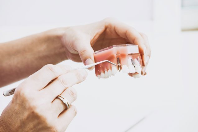 beneficios de los implantes dentales