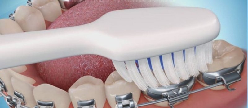 dientes-amarillos-higiene-oral-con-ortodoncia-768×499