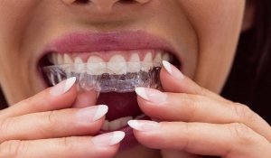 Close-up of female patient wearing braces in dental clinic