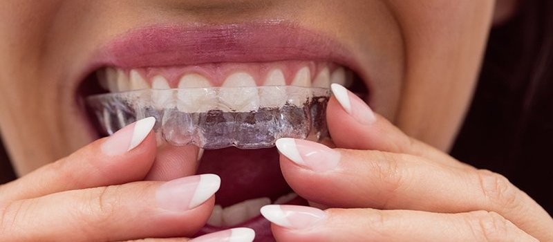 Close-up of female patient wearing braces in dental clinic