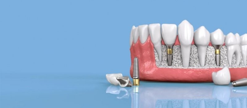implantes_dentales1-768×384