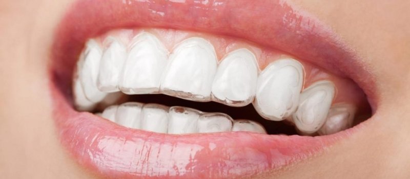 ortodoncia-con-invisalign-ventajas-1024×536
