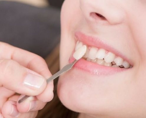 Carillas dentales: cómo saber qué tipo me conviene más
