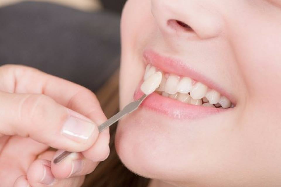 Carillas dentales: cómo saber qué tipo me conviene más