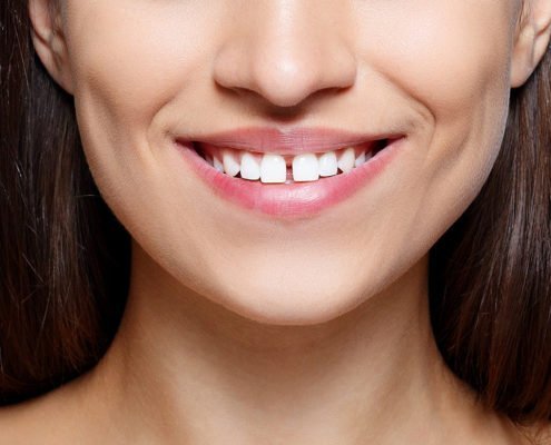 Diastema dental