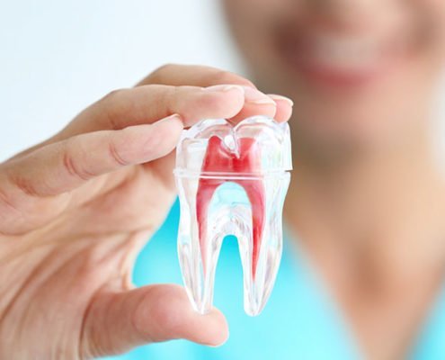 Cuándo realizar una endodoncia