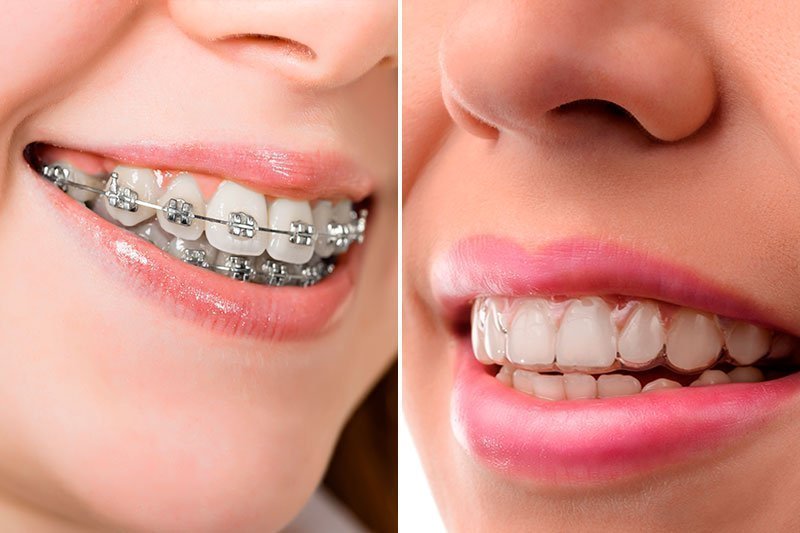 Tipos de ortodoncias: cuál elegir