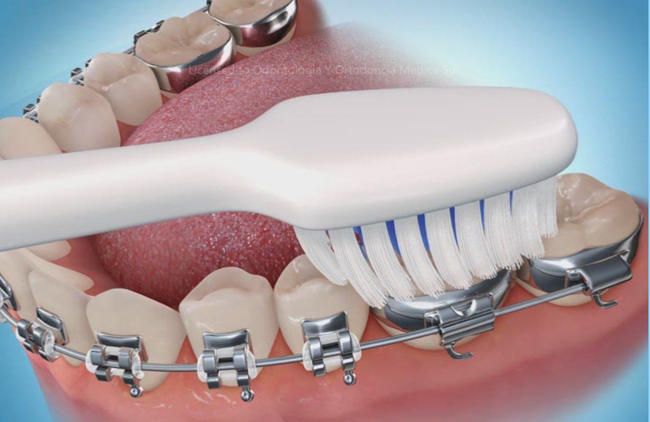dientes amarillos higiene oral con ortodoncia
