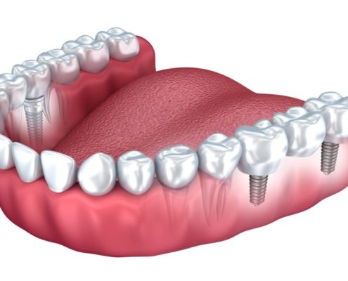 implantes dentales antiguos