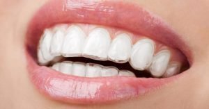 ortodoncia-con-invisalign-ventajas-1024×536