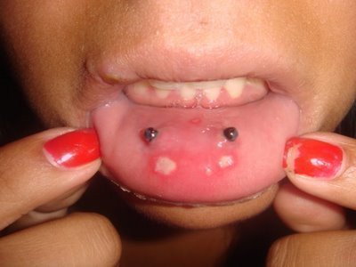 piercing infección bucal